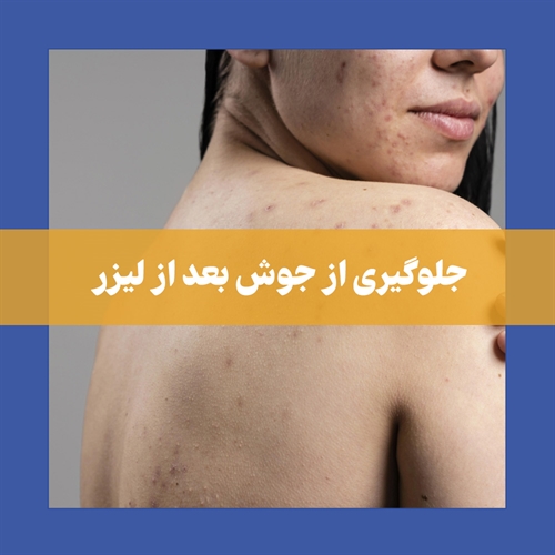 جلوگیری از جوش زدن بعد از لیزر موهای زائد