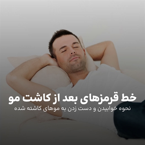 دست زدن به موهای کاشته شده + نحوه خوابیدن بعد از کاشت مو