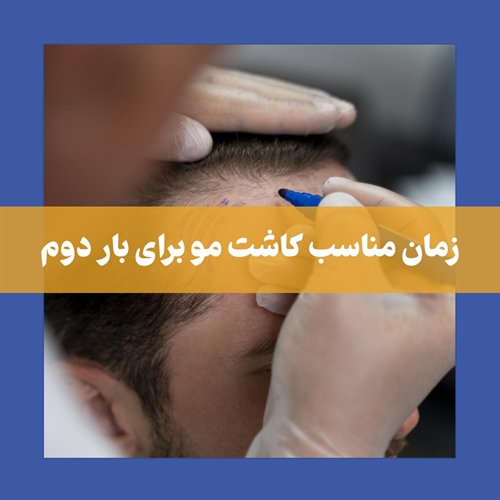 همه چیز در مورد کاشت مو برای بار دوم