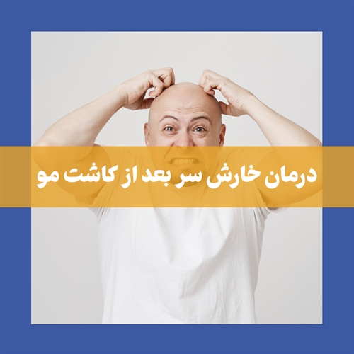 راهنمای کامل برای کاهش خارش سر بعد از کاشت مو + بررسی علت‌ها و راه‌های درمان