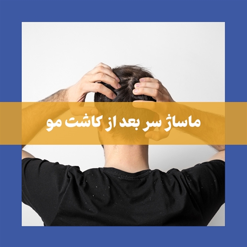 نکات مهم برای انجام ایمن ماساژ سر بعد از کاشت مو
