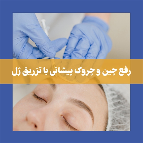 تزریق ژل پیشانی + نحوه تزريق، هزینه، مزایا و میزان ماندگاری