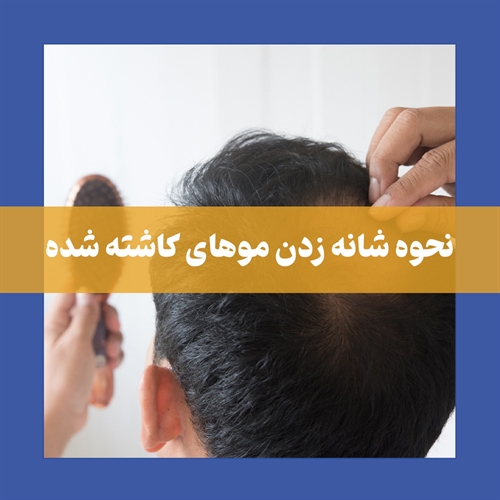 زمان مناسب برای شانه زدن بعد از کاشت مو