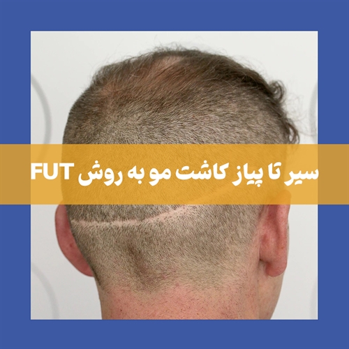 همه چیز در مورد کاشت مو به روش fut