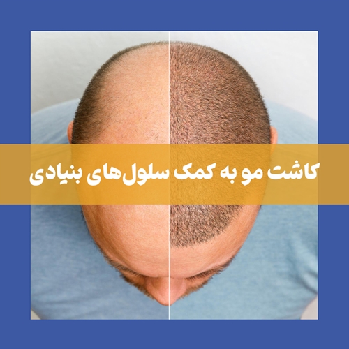 کاشت مو در شیراز به روش سلول های بنیادی