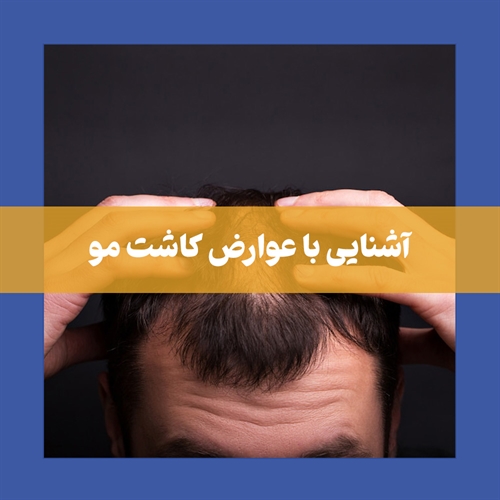 آشنایی با عوارض کاشت مو