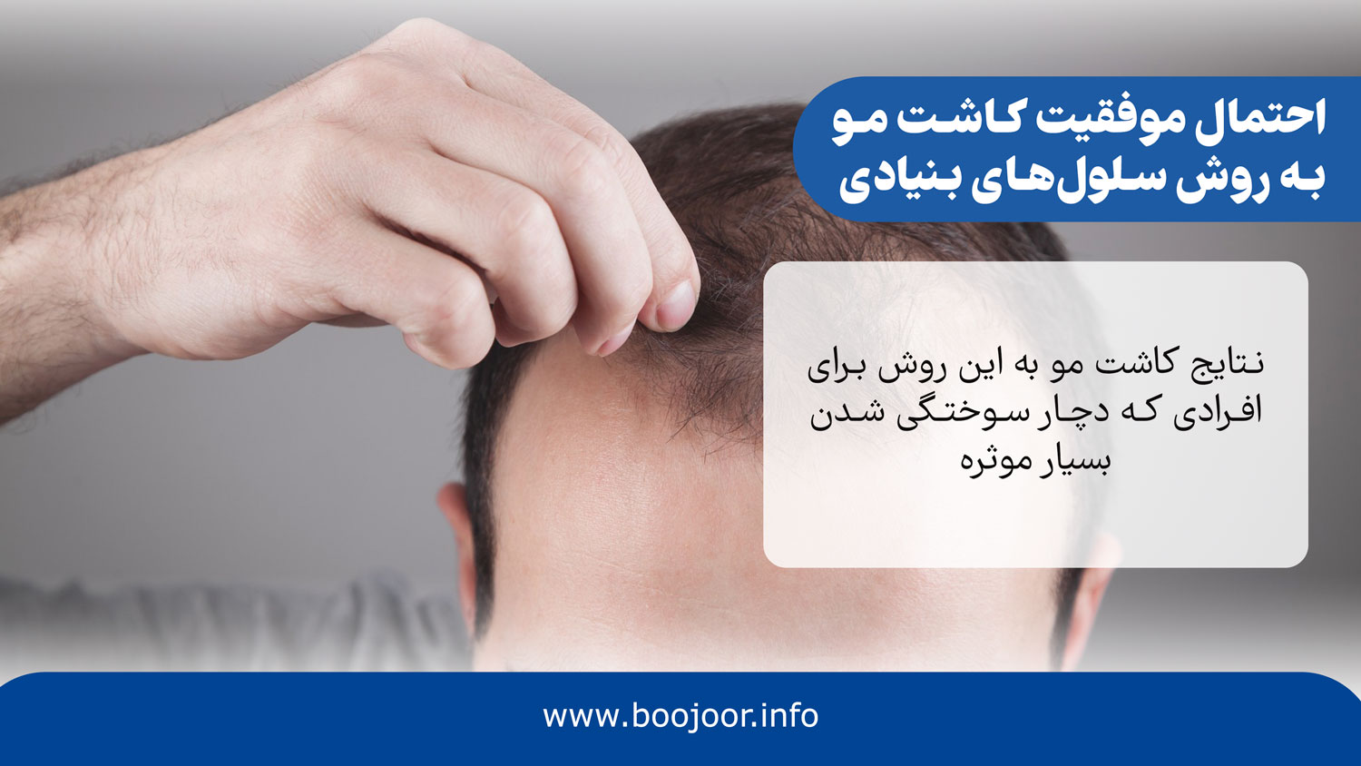 احتمال موفقیت کاشت مو به روش سلول های بنیادی