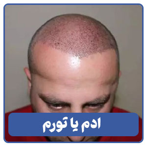 ادم یا تورم
