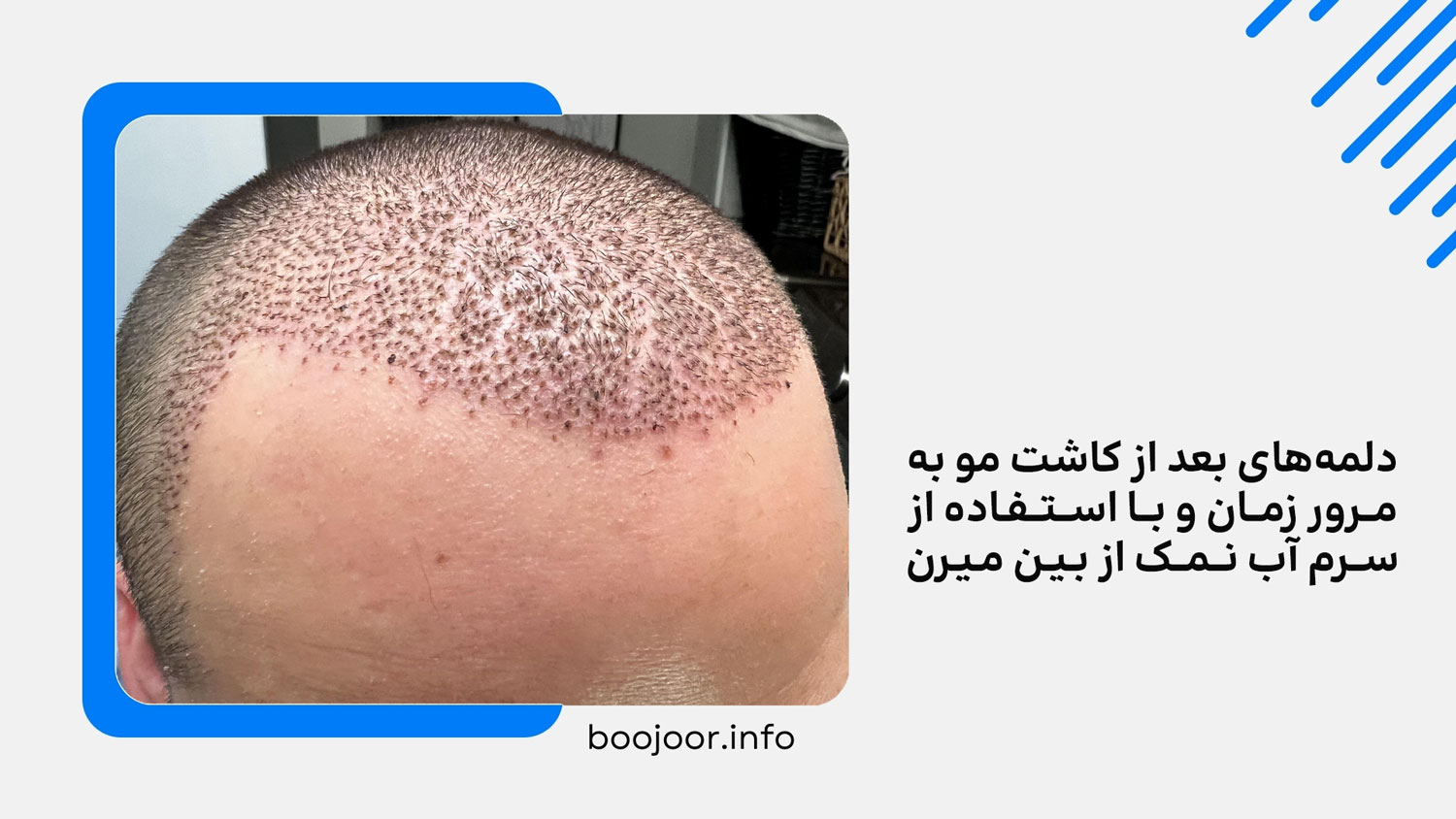 از بین رفتن دلمه بعد از کاشت مو