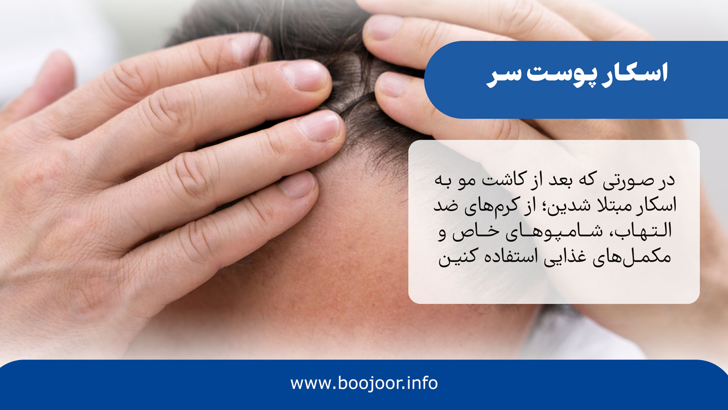 اسکار پوست سر