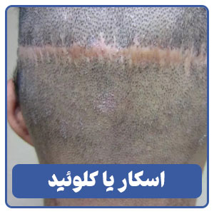 اسکار یا کلوئید هیپرتروفیک