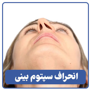 عمل انحراف سپتوم توسط بهترین جراح بینی در شیراز