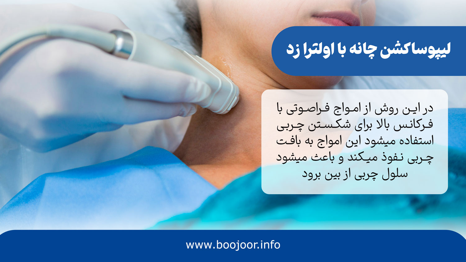 لیپوساکشن چانه با روش اولترا زد