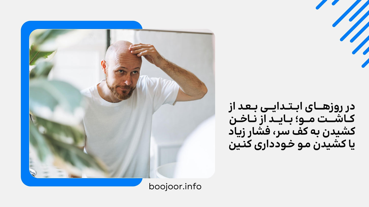 آیا لمس سر بعد از کاشت مو مجاز است