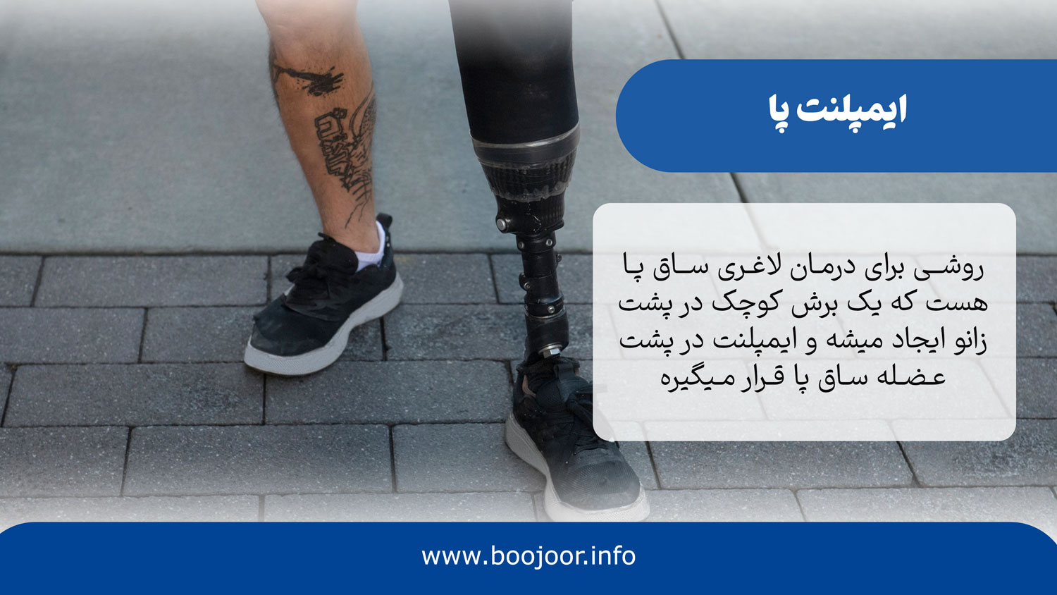 ایمپلنت پا