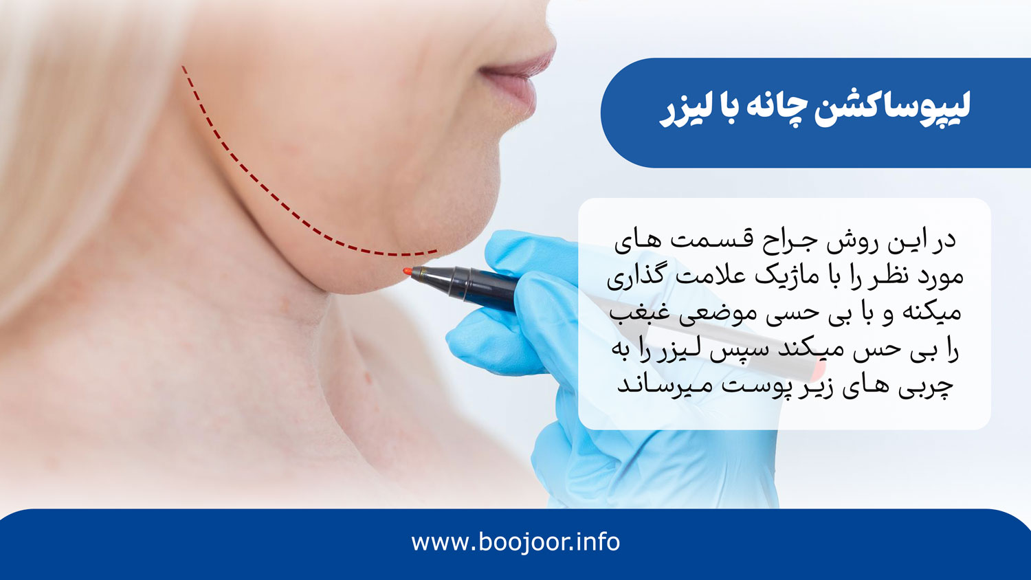 لیپوساکشن چانه با لیزر
