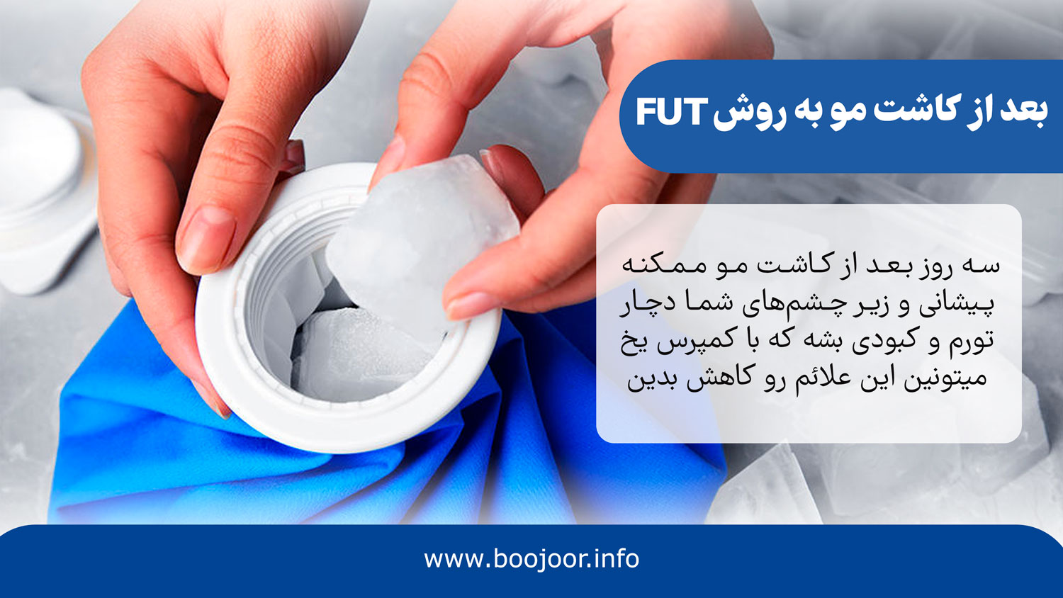 بعد از کاشت مو به روش fut
