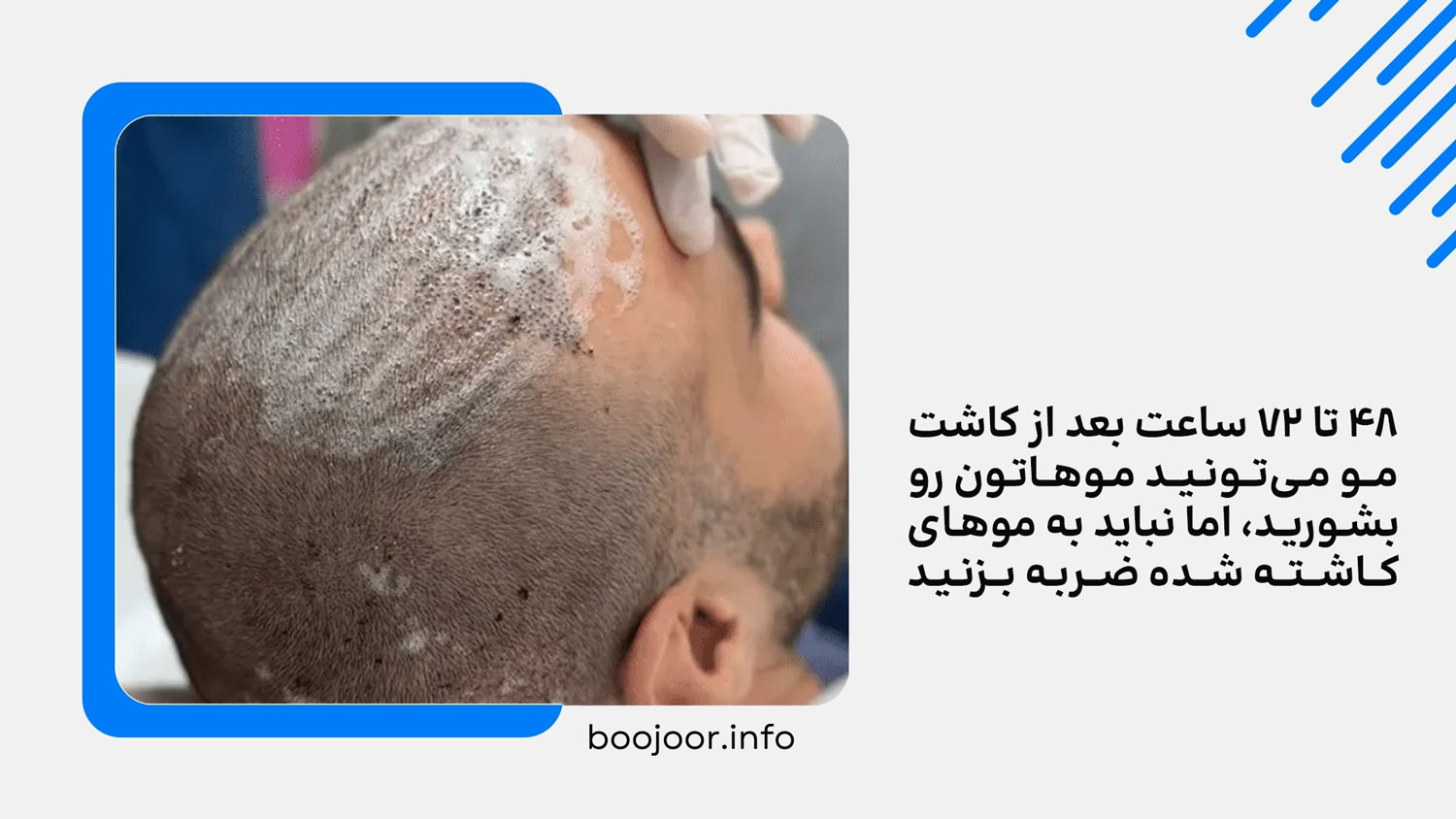 بهترین زمان شستشوی موهای کاشته شده