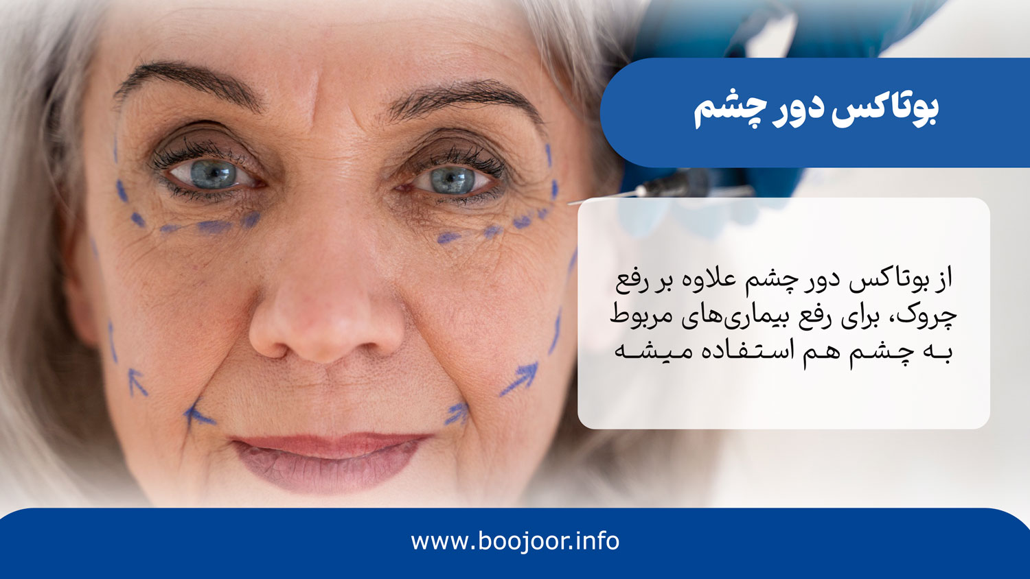 بوتاکس دور چشم