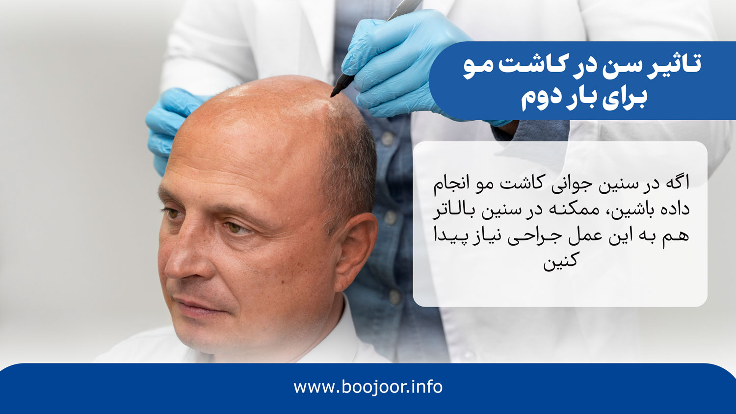 تاثیر سن در کاشت مو برای بار دوم