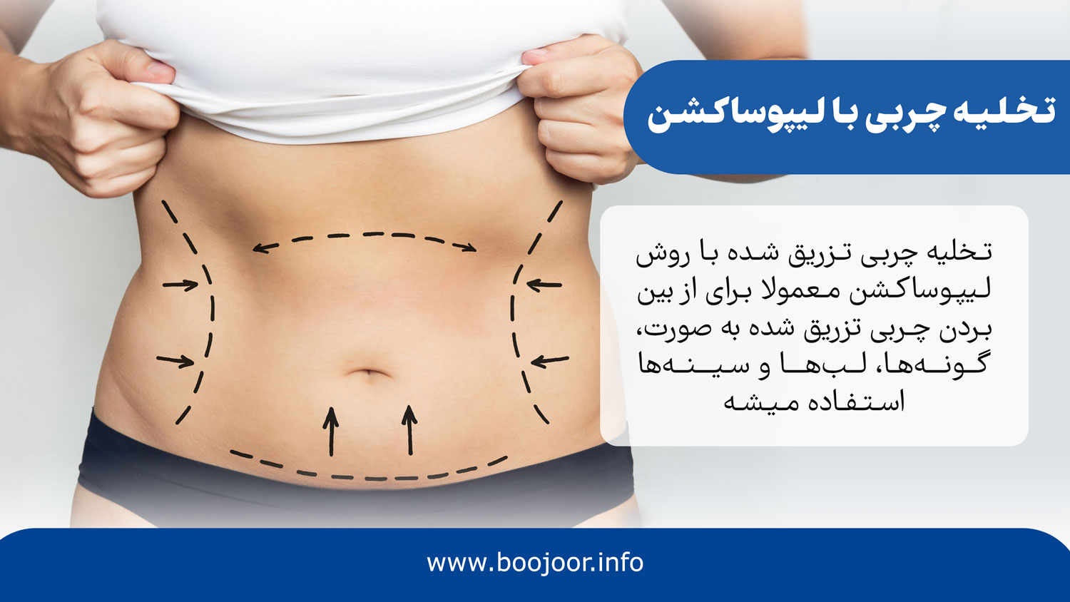 تخلیه چربی تزریق شده با لیپوساکشن