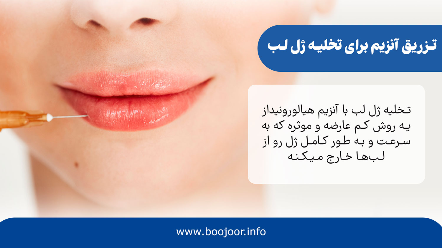تزریق آنزیم برای تخلیه ژل لب