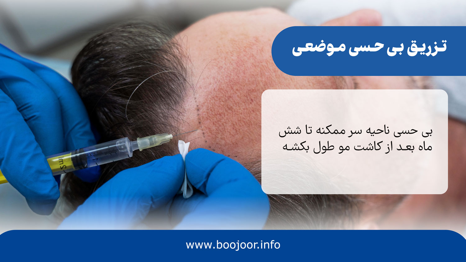 تزریق بی حسی موضعی