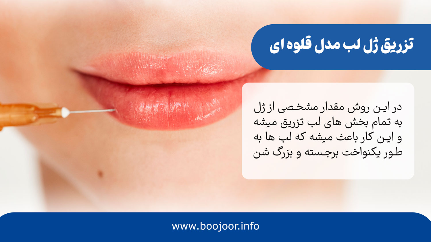 تزریق ژل لب مدل قلوه ای