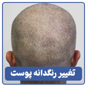  تغییر رنگدانه پوست