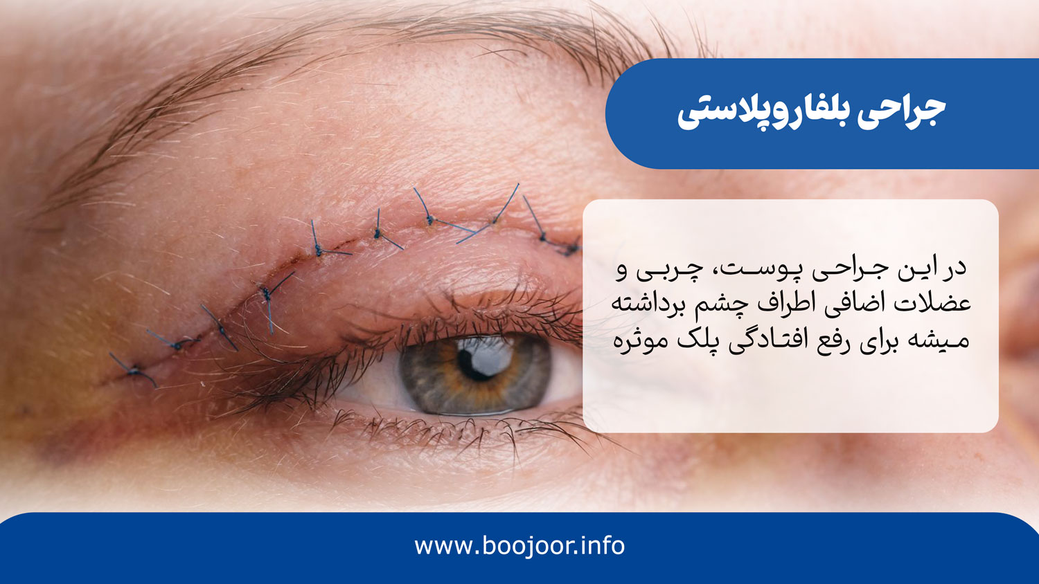 جاحی بلفاروپلاسنی