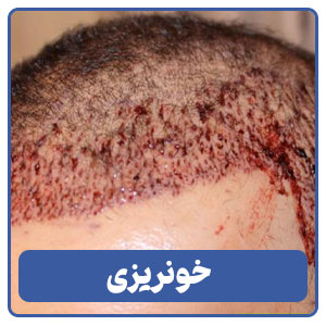خونریزی