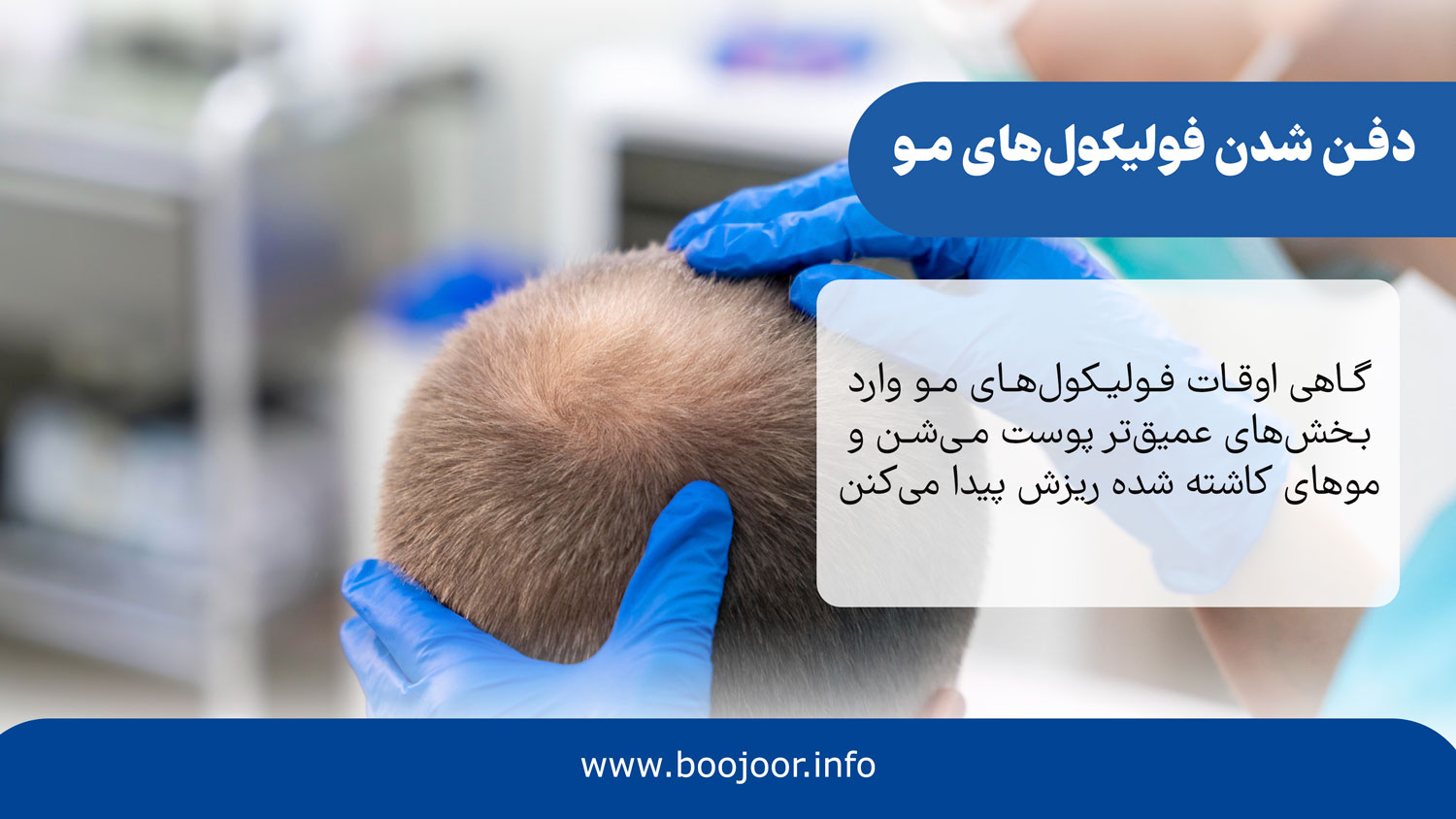 دفن شدن فولیکول های مو
