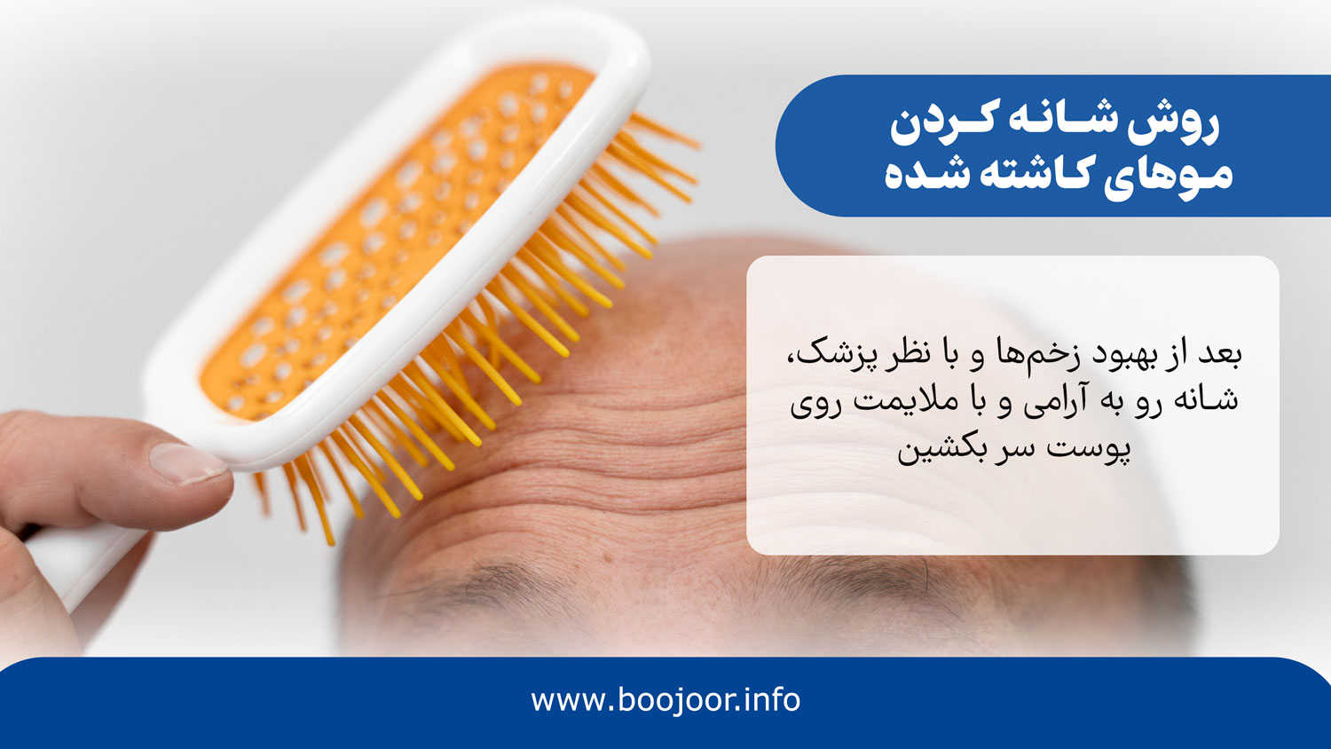 روش شانه کردن موهای کاشته شده