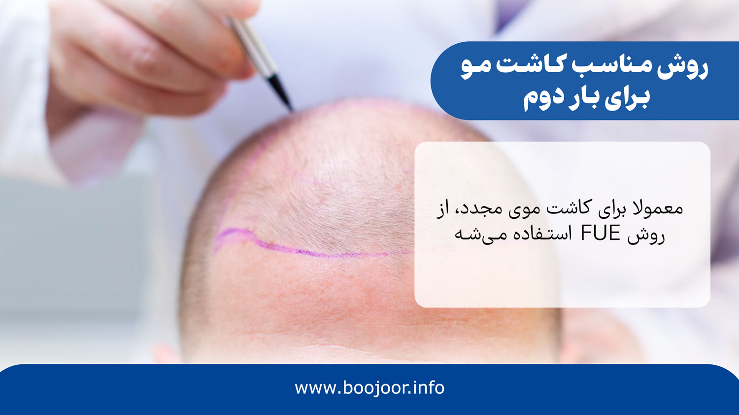 روش مناسب کاشت مو برای بار دوم
