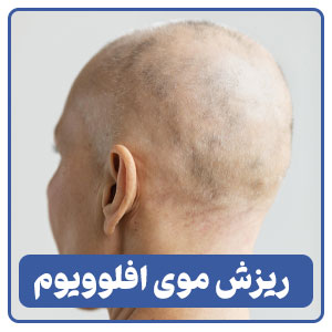 ریزش موی افلوویوم