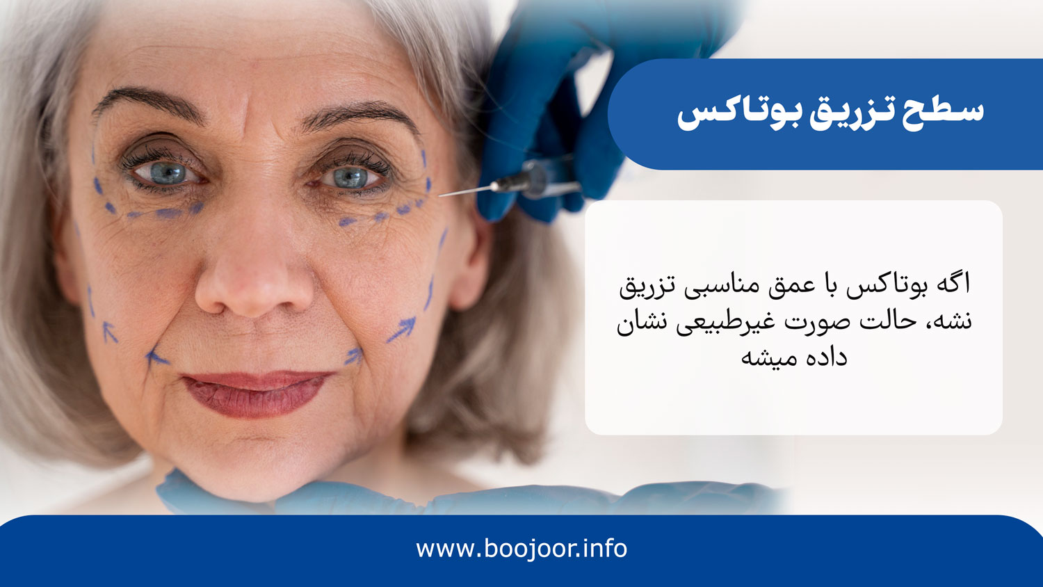 سطح تزریق بوتاکس