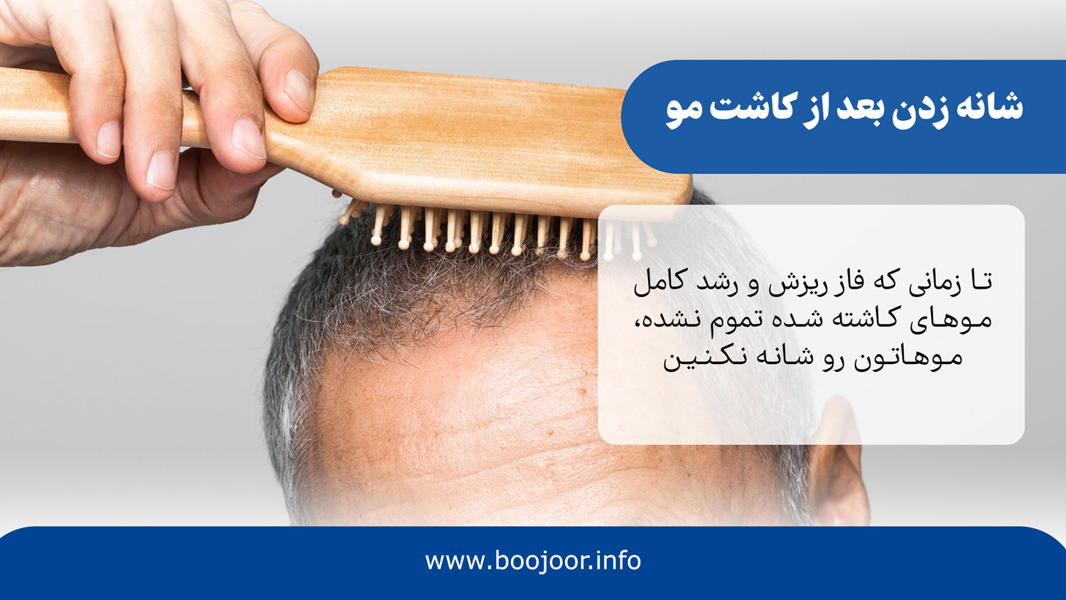 شانه زدن بعد از کاشت مو