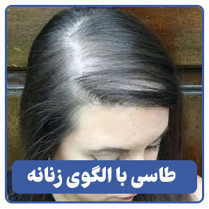 طاسی با الگوی زنانه