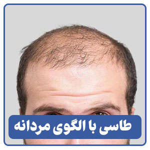 طاسی با الگوی مردانه