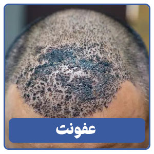 عفونت
