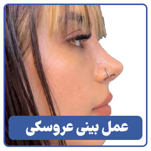 عمل بینی عروسکی توسط بهترین جراح بینی در شیراز