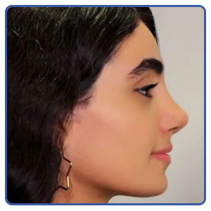 عمل بینی نیمه فانتزی نوک گرد
