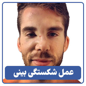 عمل شکستگی بینی توسط بهترین جراح بینی در شیراز