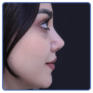 عمل نیمه فانتزی بینی گوشتی