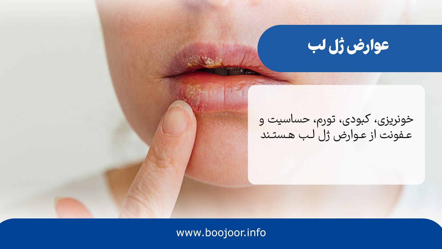 عوارض ژل لب