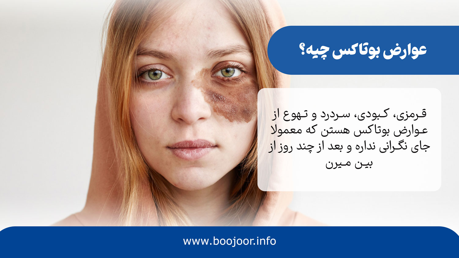 عوارض بوتاکس