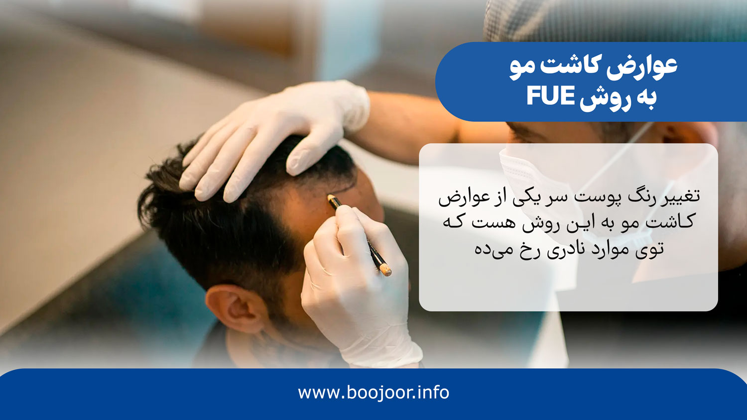 عوارض کاشت مو به روش FUE