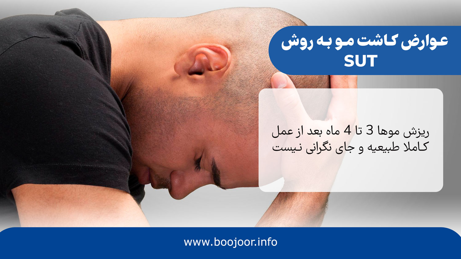 عوارض کاشت مو به روش sut