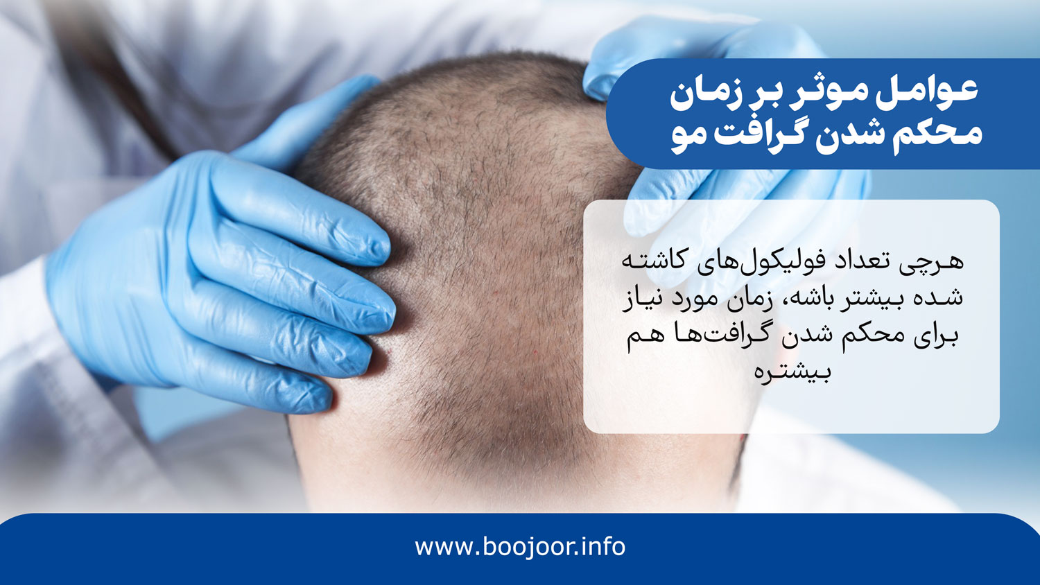 عوامل موثر بر زمان محکم شدن گرافت مو