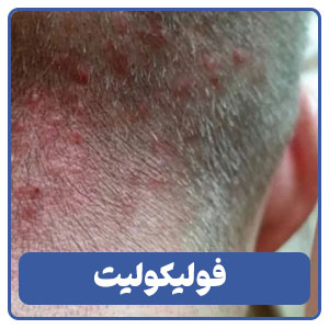 فولیکولیت